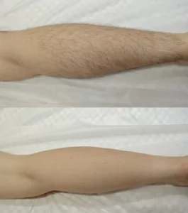 laser hair removal for arm treatment