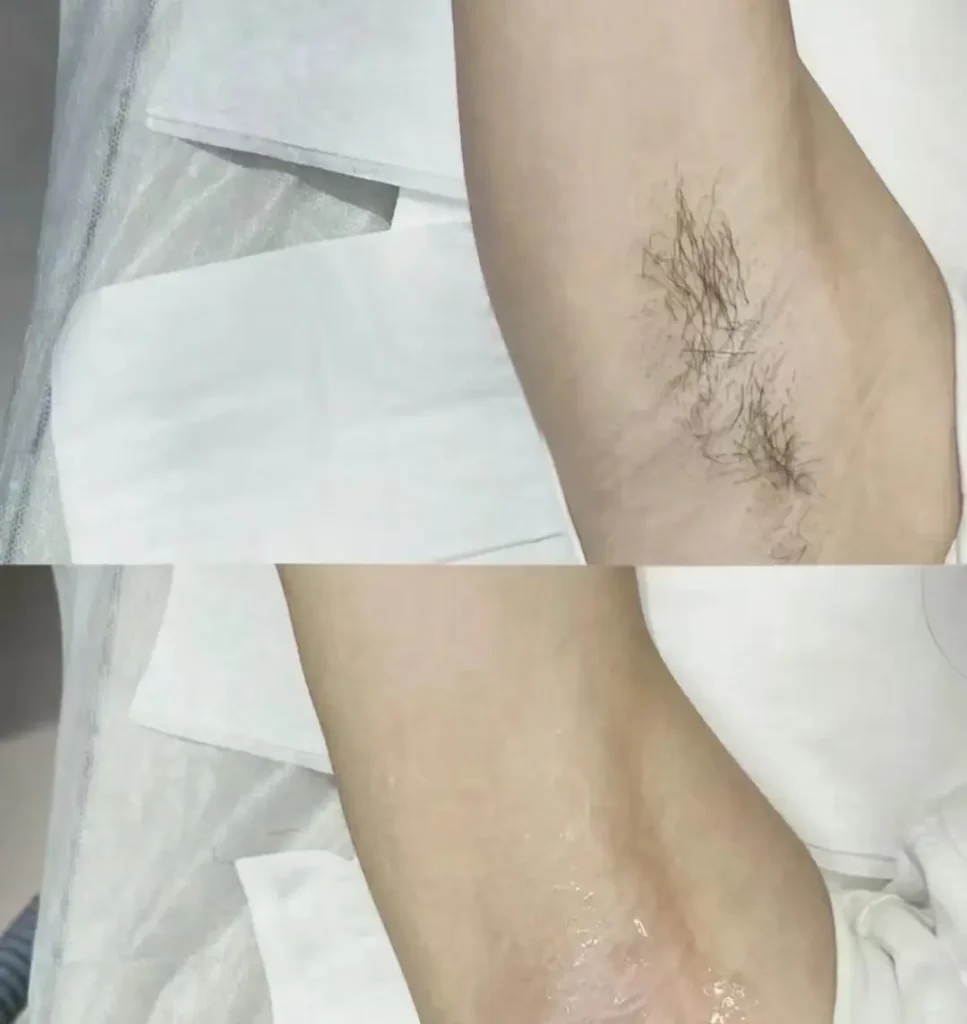 GentleMax Pro Laser hair removal