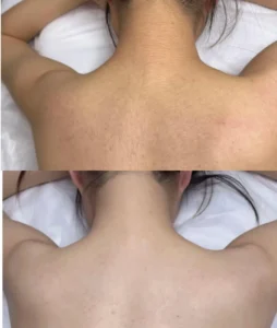 GentleMax Pro Laser hair removal