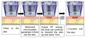 Radiofrequency microneedling for acne scars