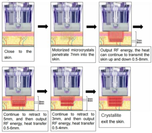 Professional skin tightening equipment