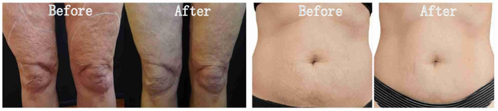 Microneedling RF