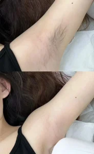 Diode laser hair removal