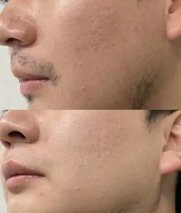 laser hair removal feedback