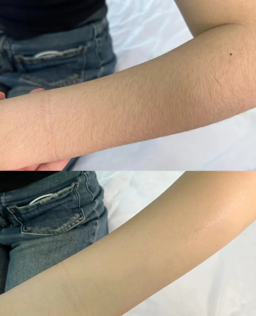 feedback Diode laser hair removal
