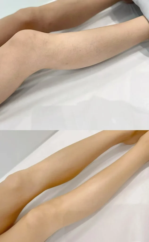 Diode laser hair removal treatment