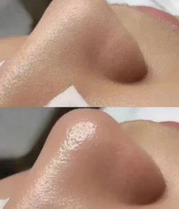 REASULTS OF HYDRAFACIAL TREATMENT