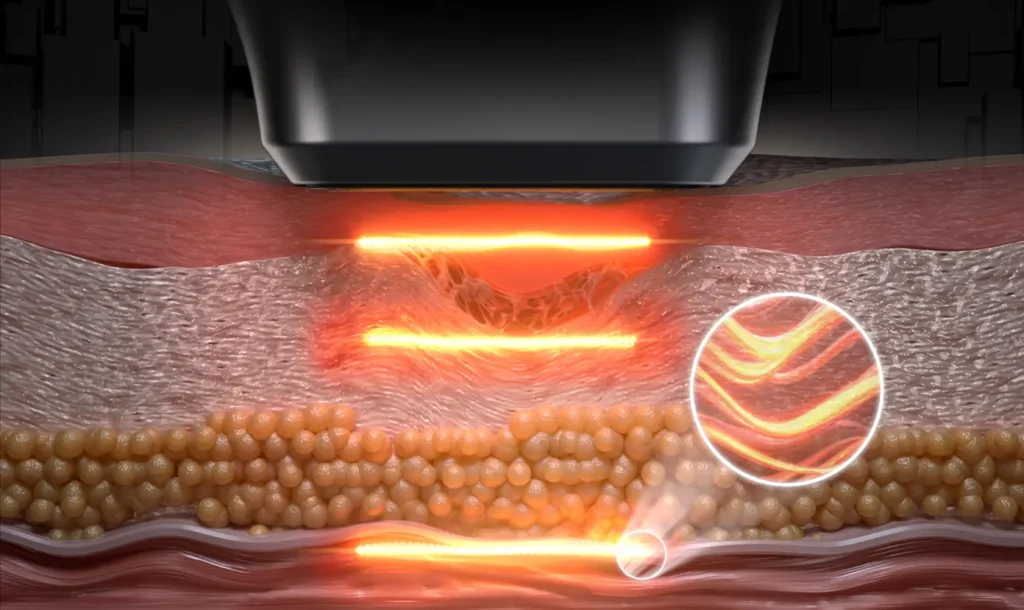 HIFU face lifting wrinkle removal