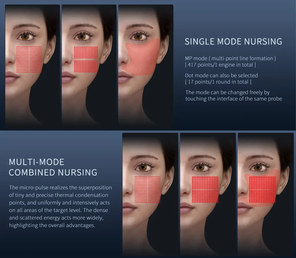 HIFU face lifting wrinkle removal