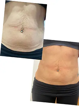 body shaping for hifu treatment