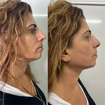 jaw lifting for hifu treatment