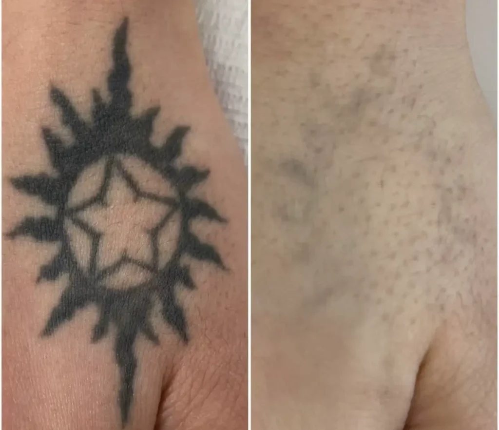 2 in 1 laser