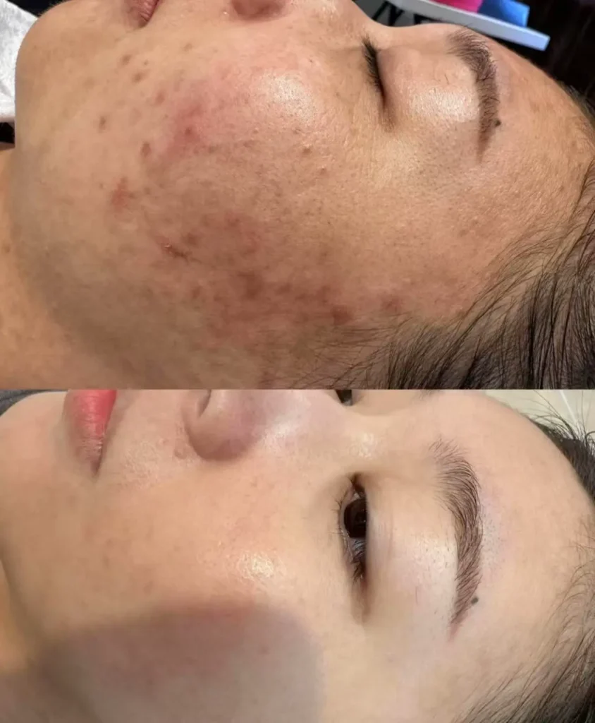 Fusion Plasma Skin Repair