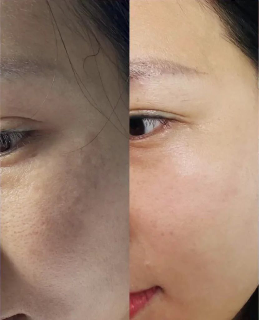 Fusion Plasma Skin Repair