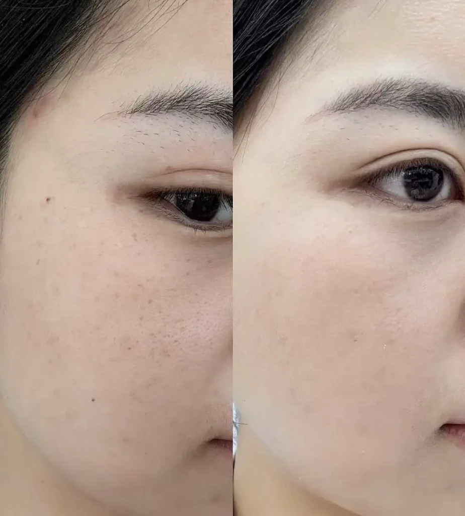 Fusion Plasma Skin Repair