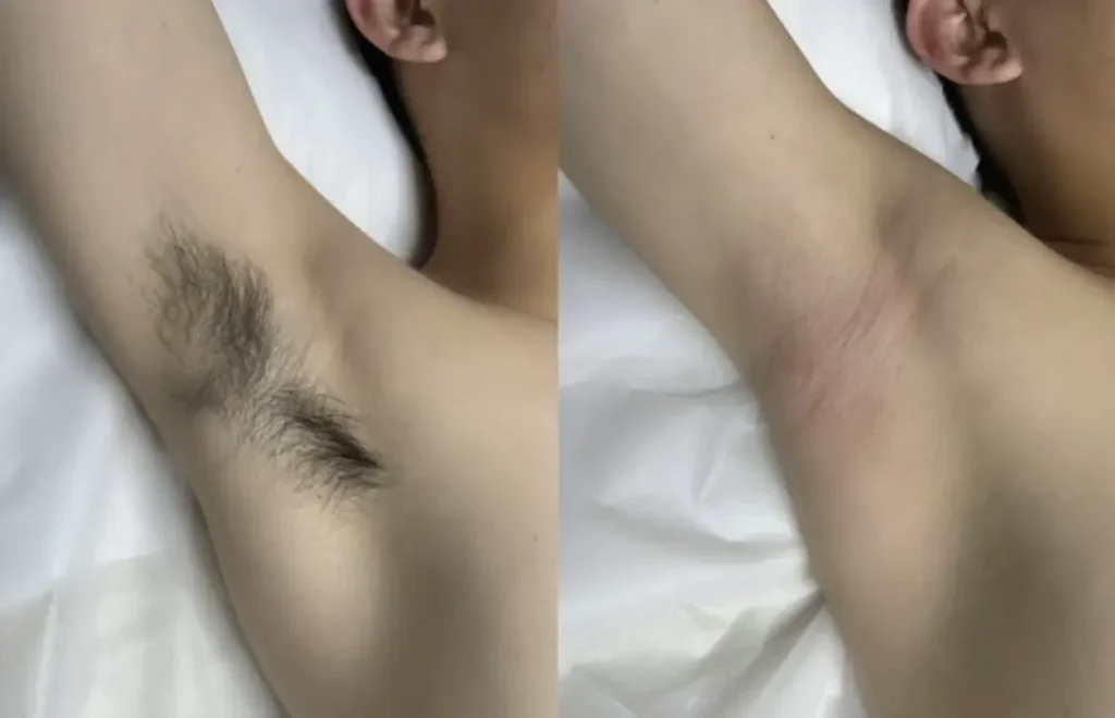 painless hair removal device