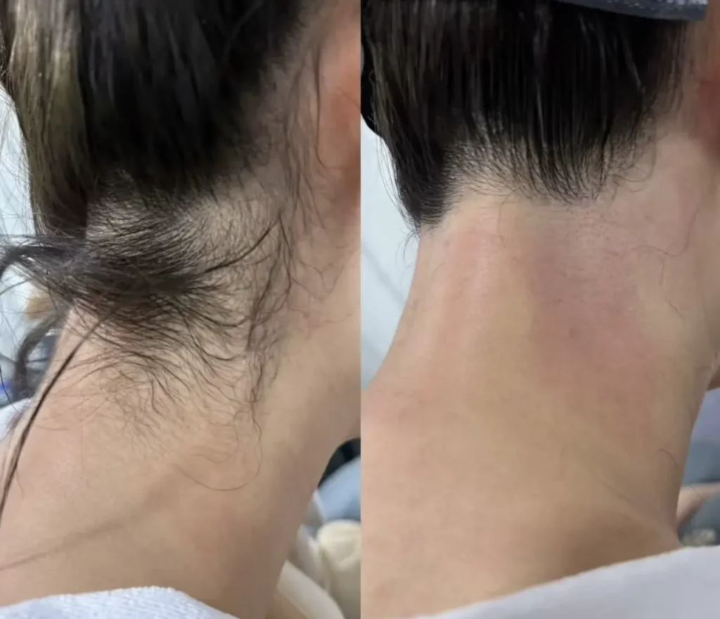 2 in 1 laser