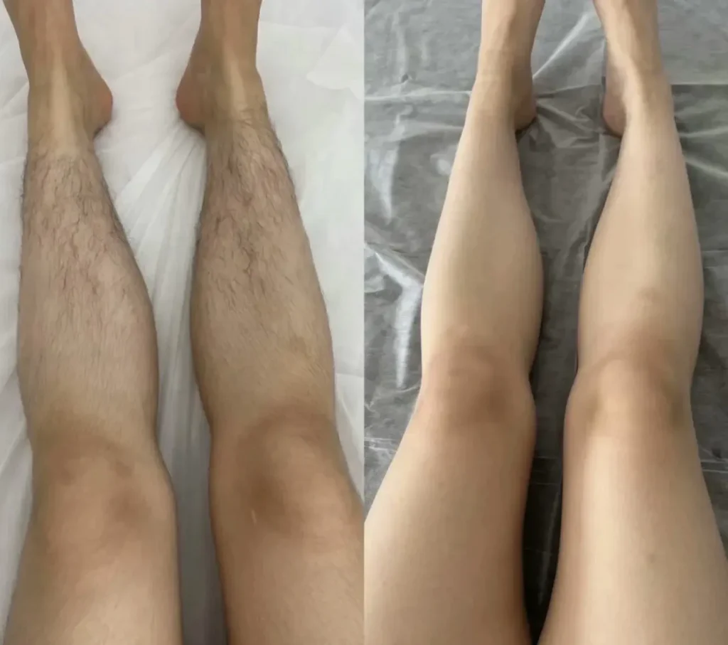 professional diode laser hair removal