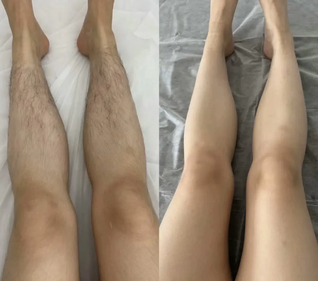 professional diode laser hair removal