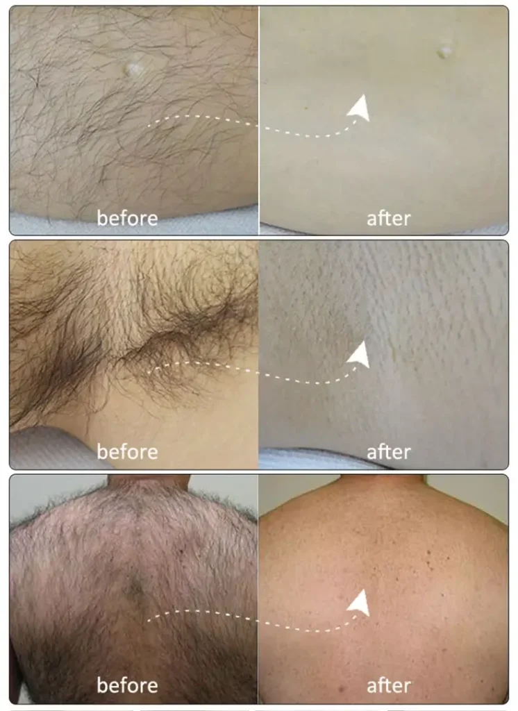 laser hair removal