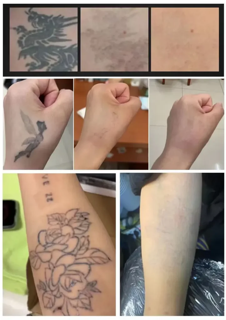 laser tattoo removal