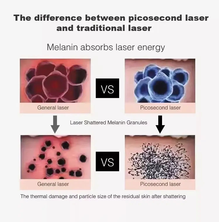 picosecond laser