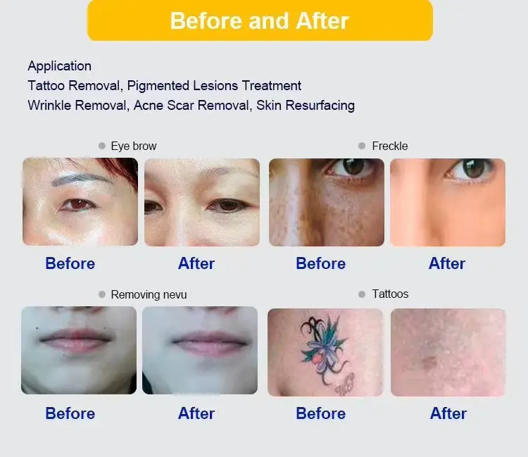 picosecond laser