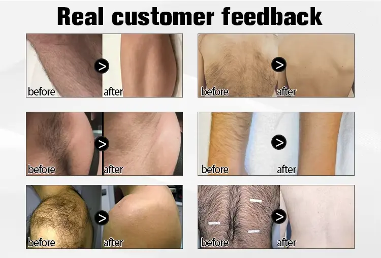 diode laser hair removal