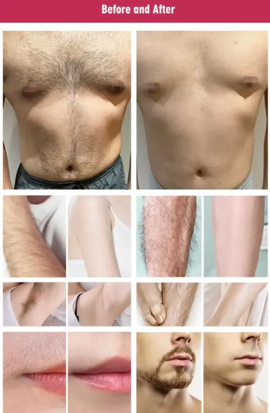 diode laser hair removal