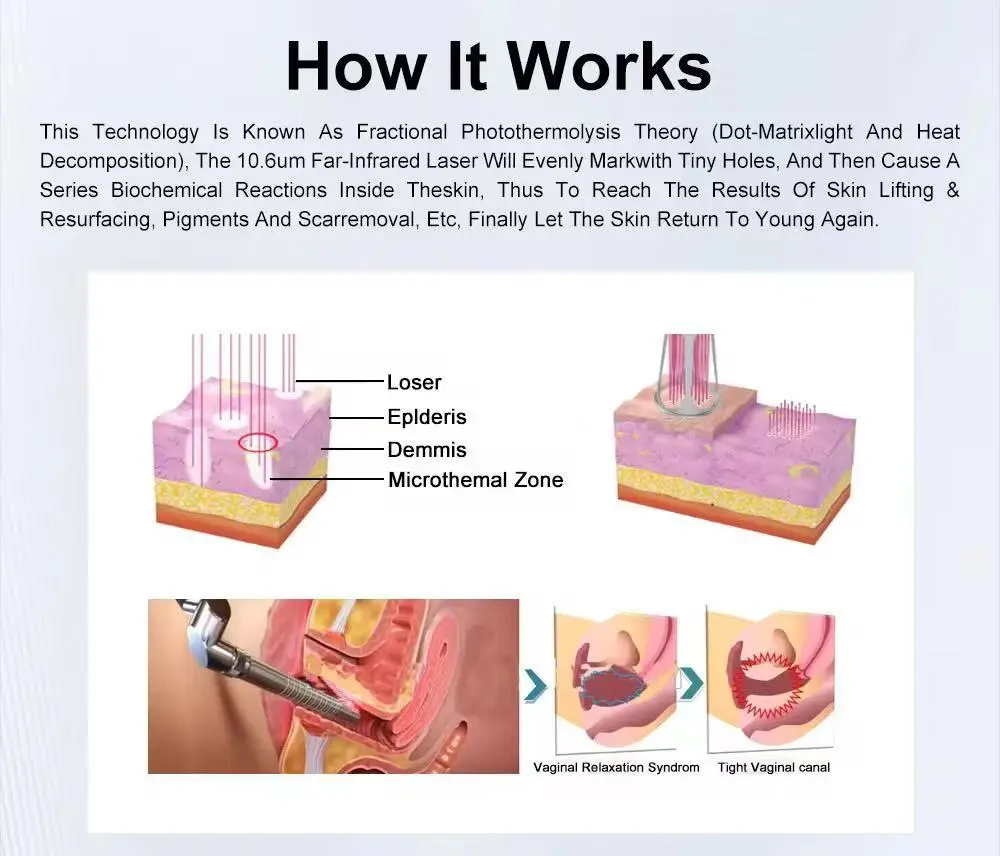 Fractional co2 laser