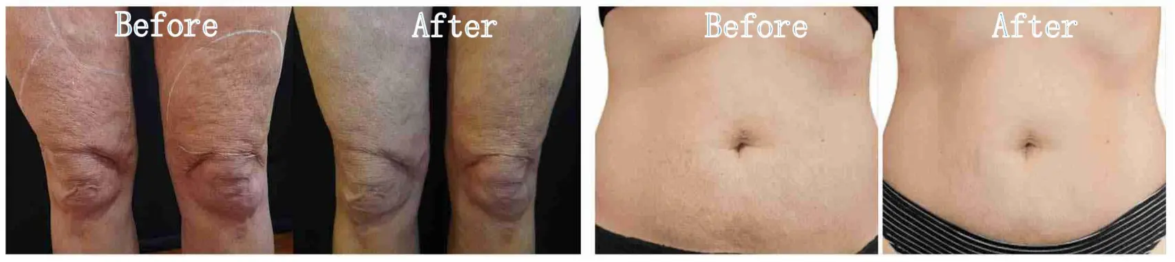 microneedling RF machine