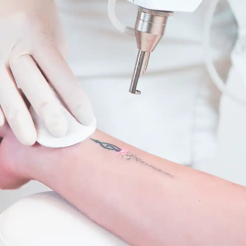 buy laser tattoo removal machine