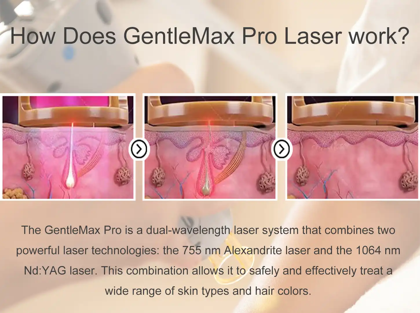 Alexandrite laser machine