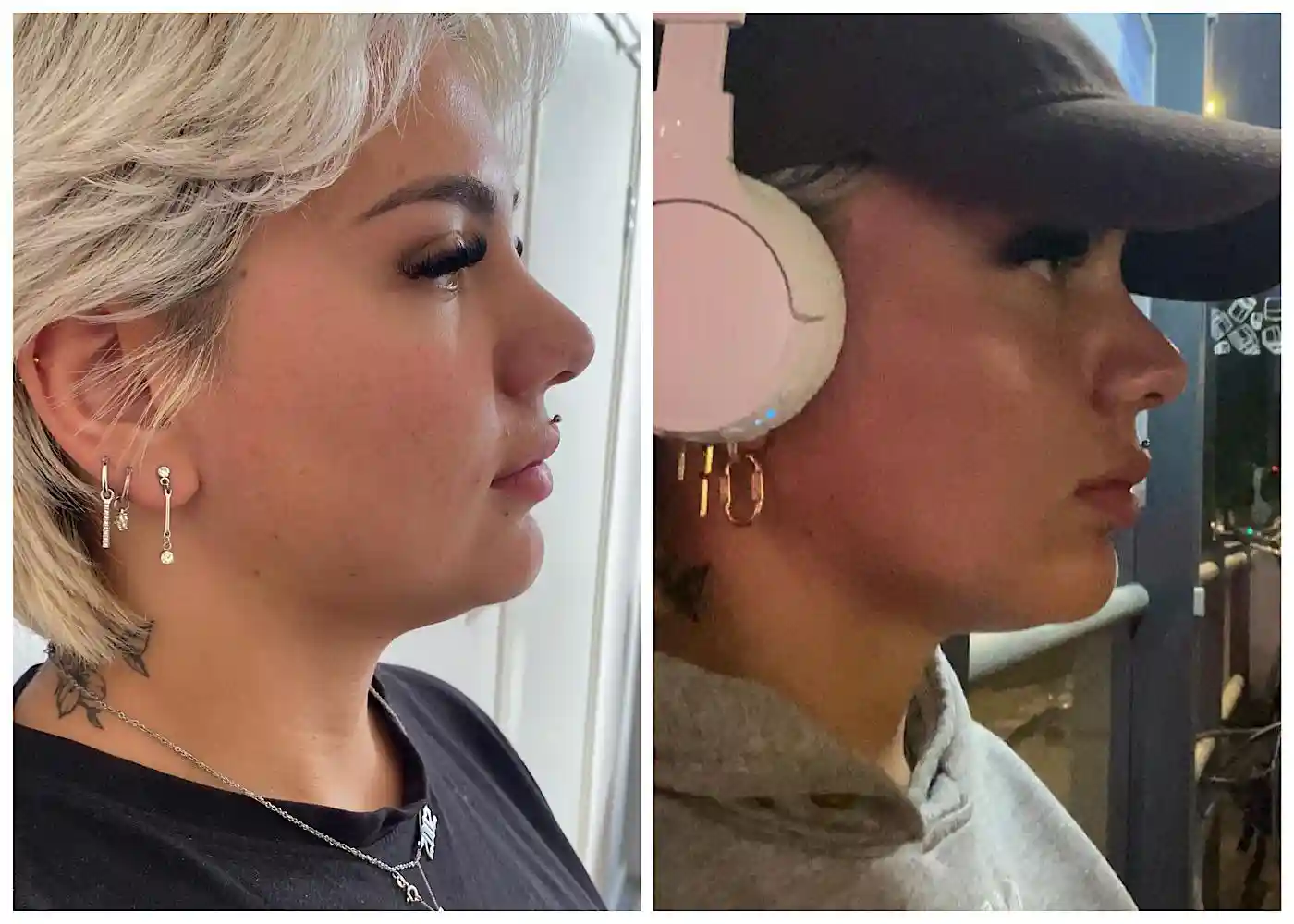 HIFU facial machine