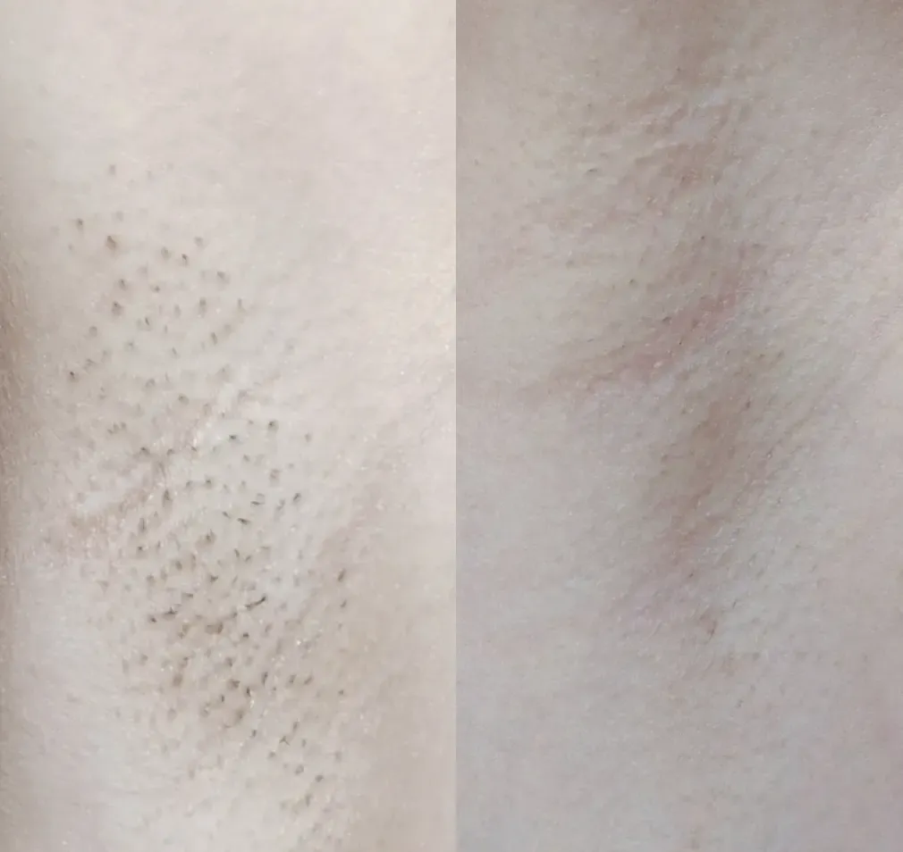 Jade salon owner in London with professional diode laser hair removal machine