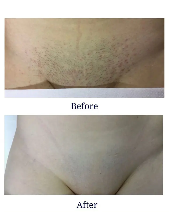 Soprano Ice Laser Hair Removal result