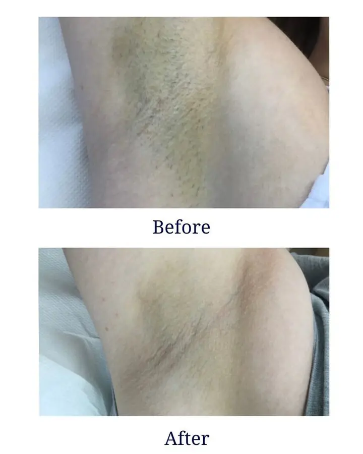 Sylvia salon owner in California with diode laser machine
