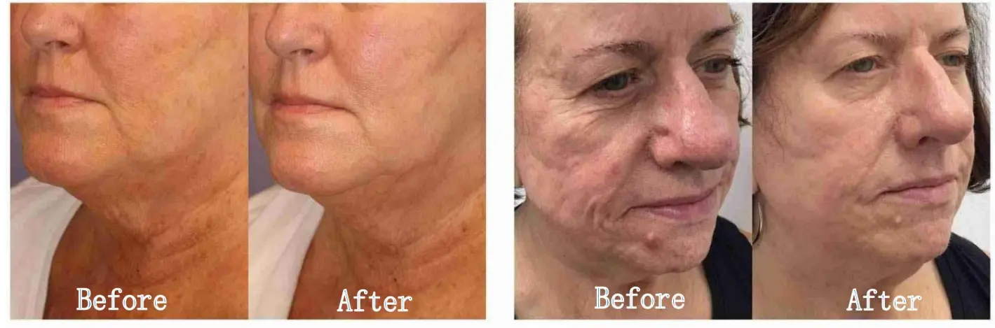 microneedling RF machine