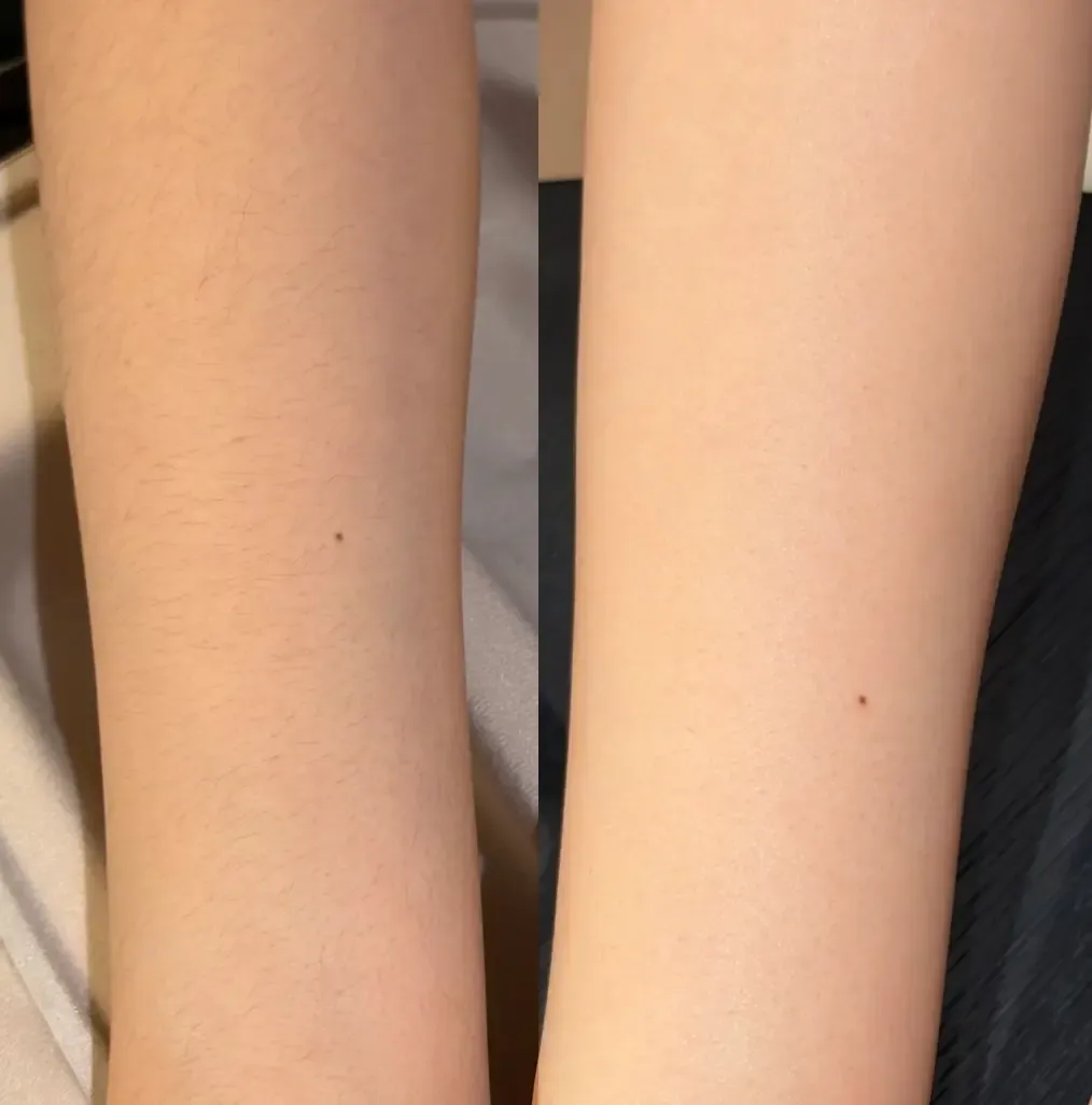 before and after