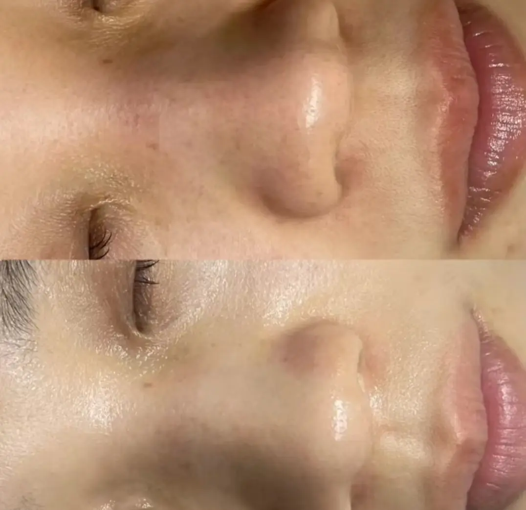 Hydrafacial machine