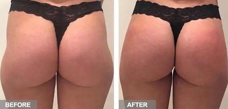 body slimming feedback