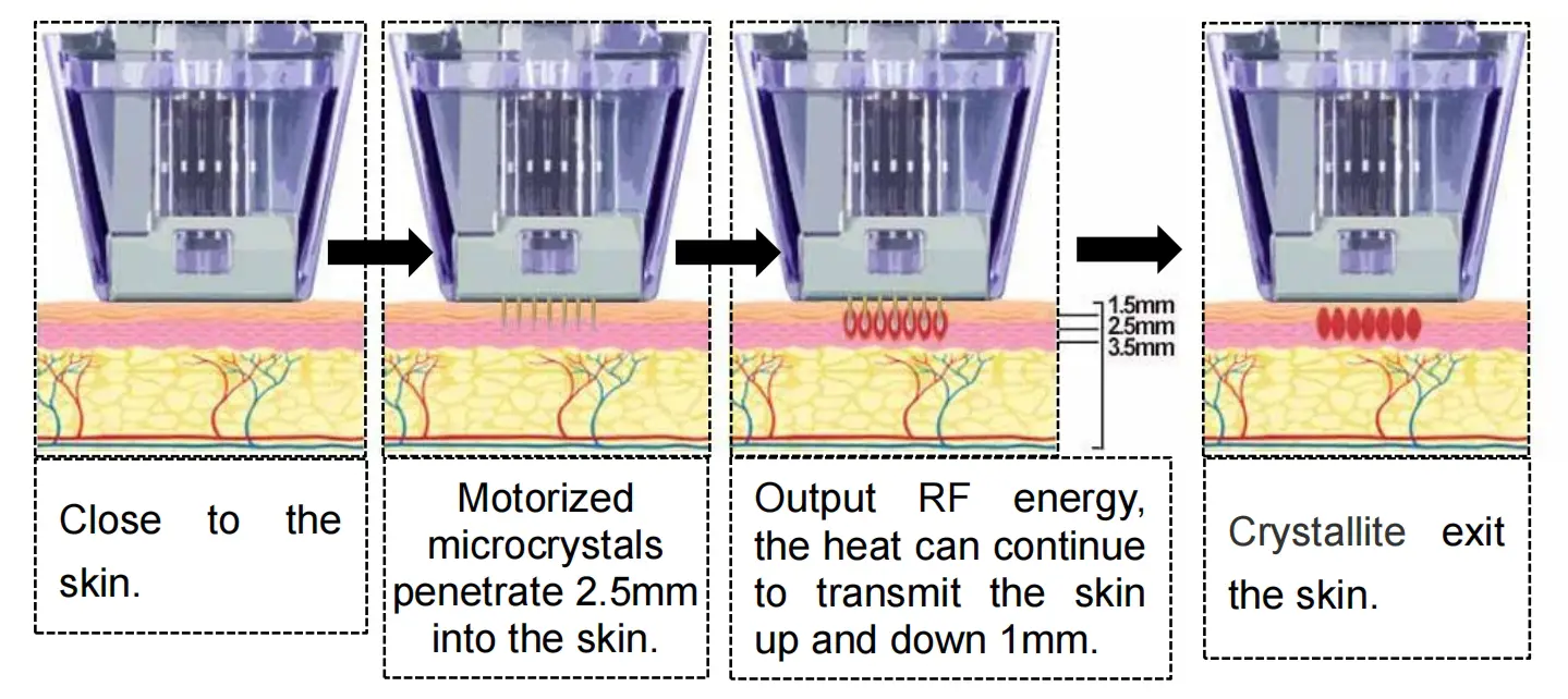 Microneedling RF machine