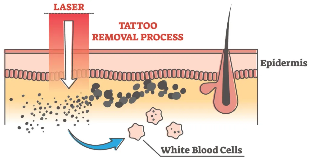 Principles of Tattoo Removal Machines