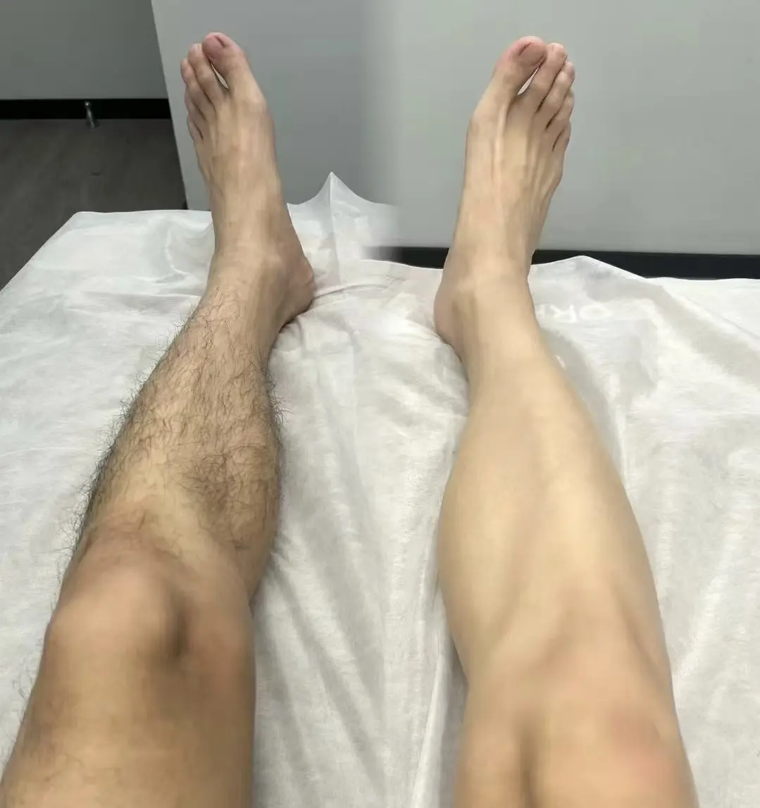 laser hair removal machine